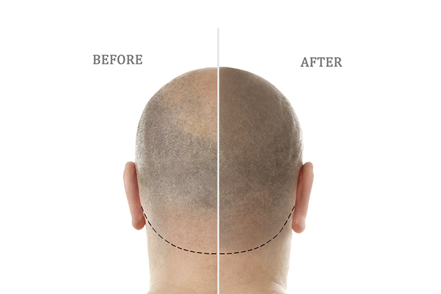 Hair Transplant in Indore | Hair Loss Treatment | Dr Nishant Khare Hair Transplant in Indore | Hair Loss Treatment | Dr Nishant Khare