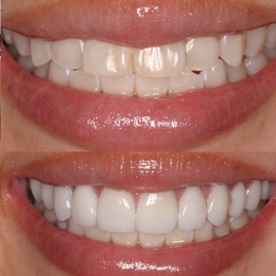 img-veneers