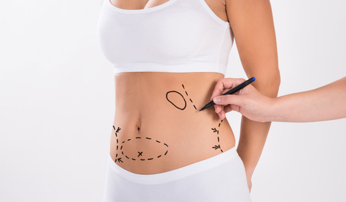 liposuction in Indore