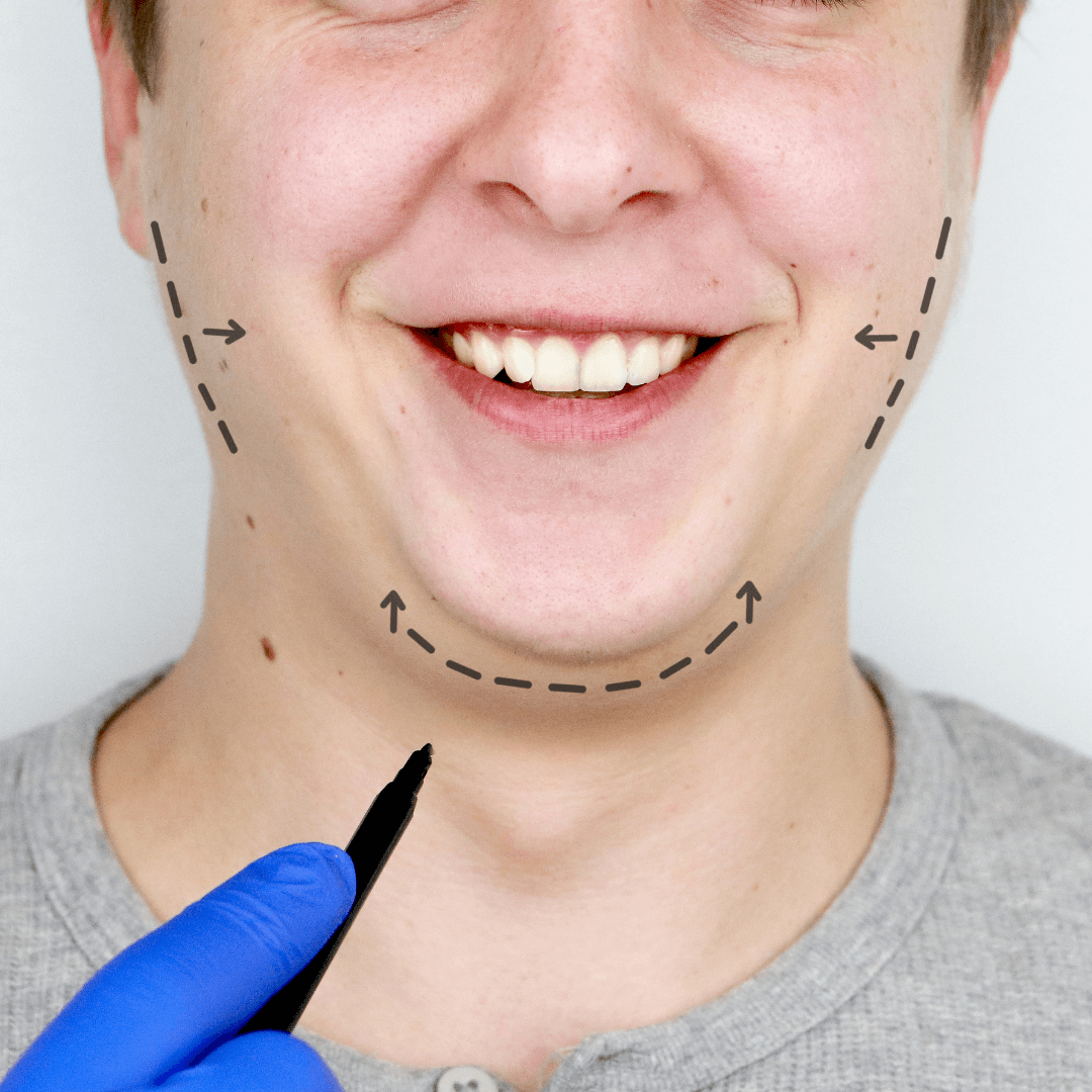 genioplasty