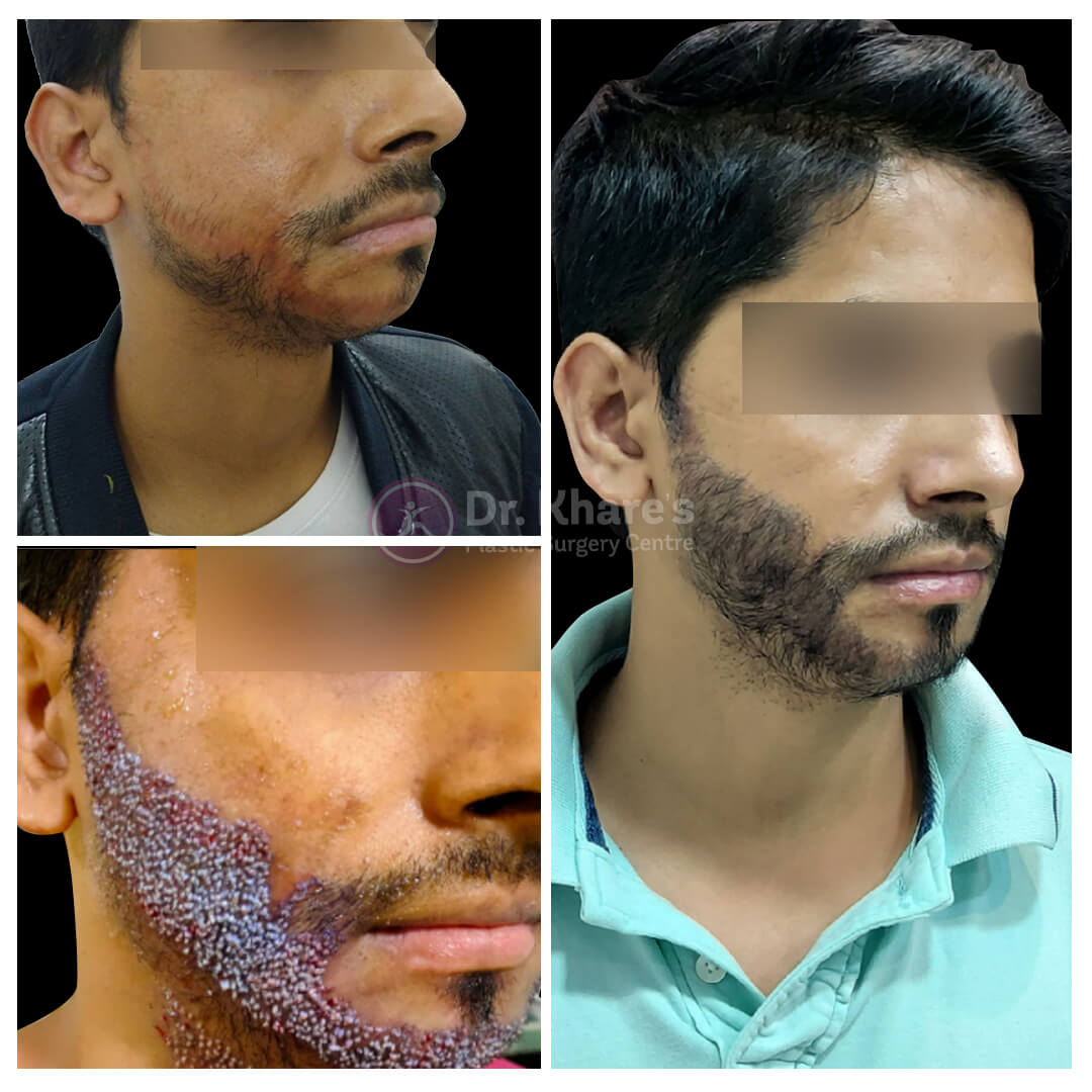 Hair | Dr. Nishant Khare (Plastic Surgeon) Indore Hair | Dr. Nishant Khare (Plastic Surgeon) Indore